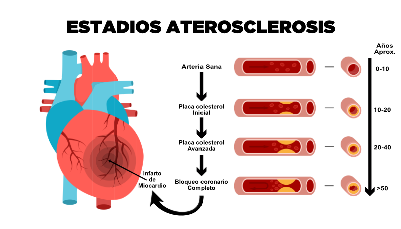 Revertir la aterosclerosis coronaria cambiando tu estilo de vida